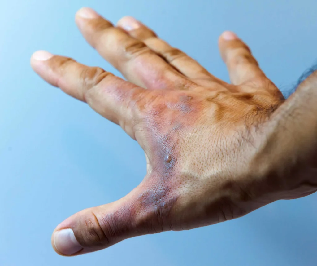 Chemical Burns