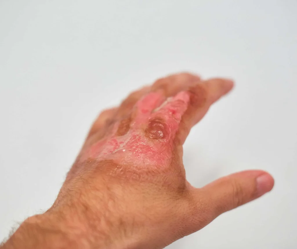 Electrical Burns
