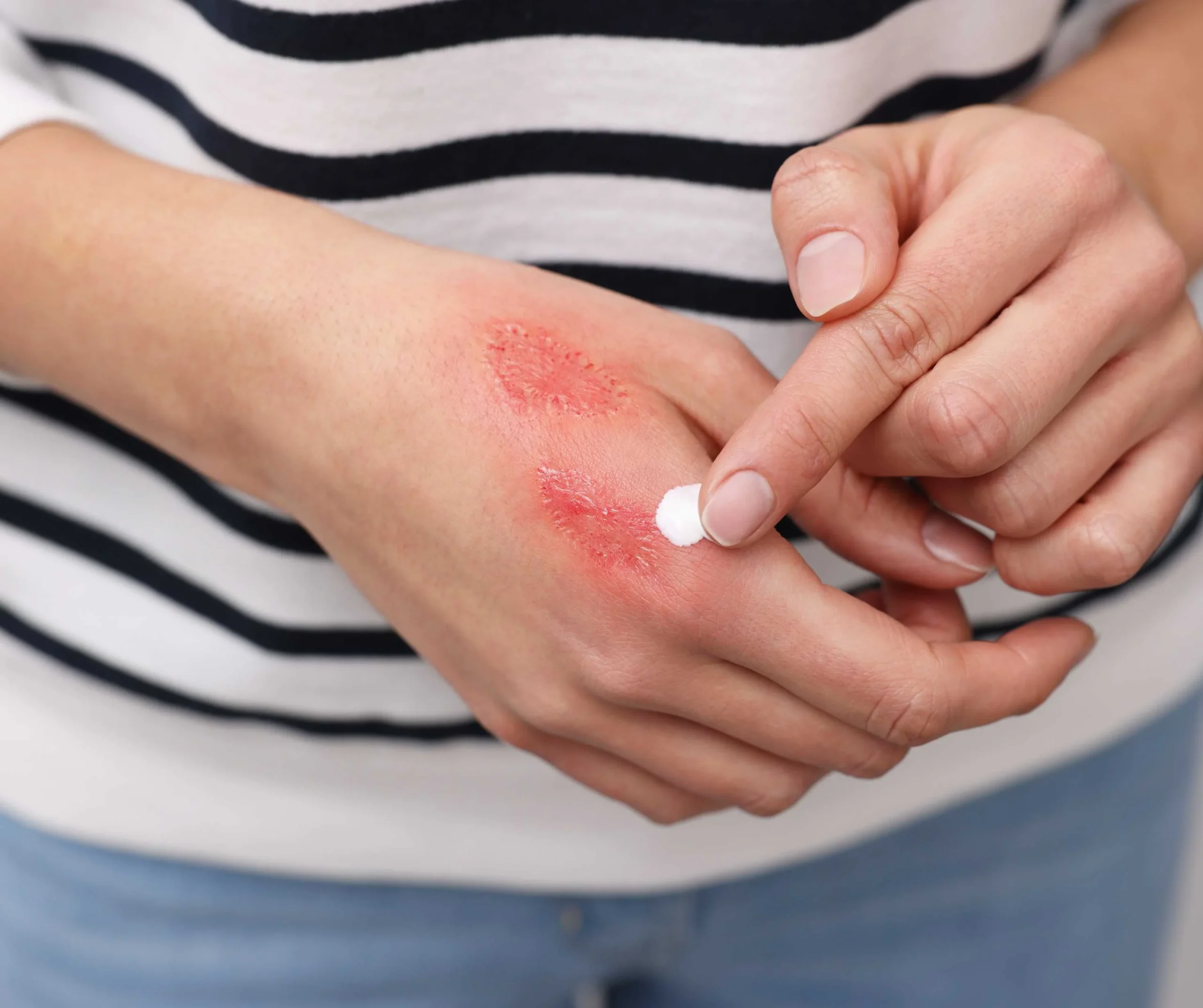 First-Degree Burns