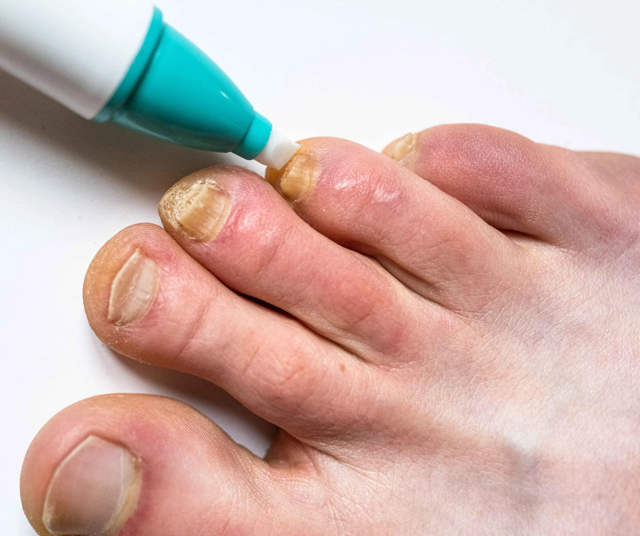 Fungal Infection
