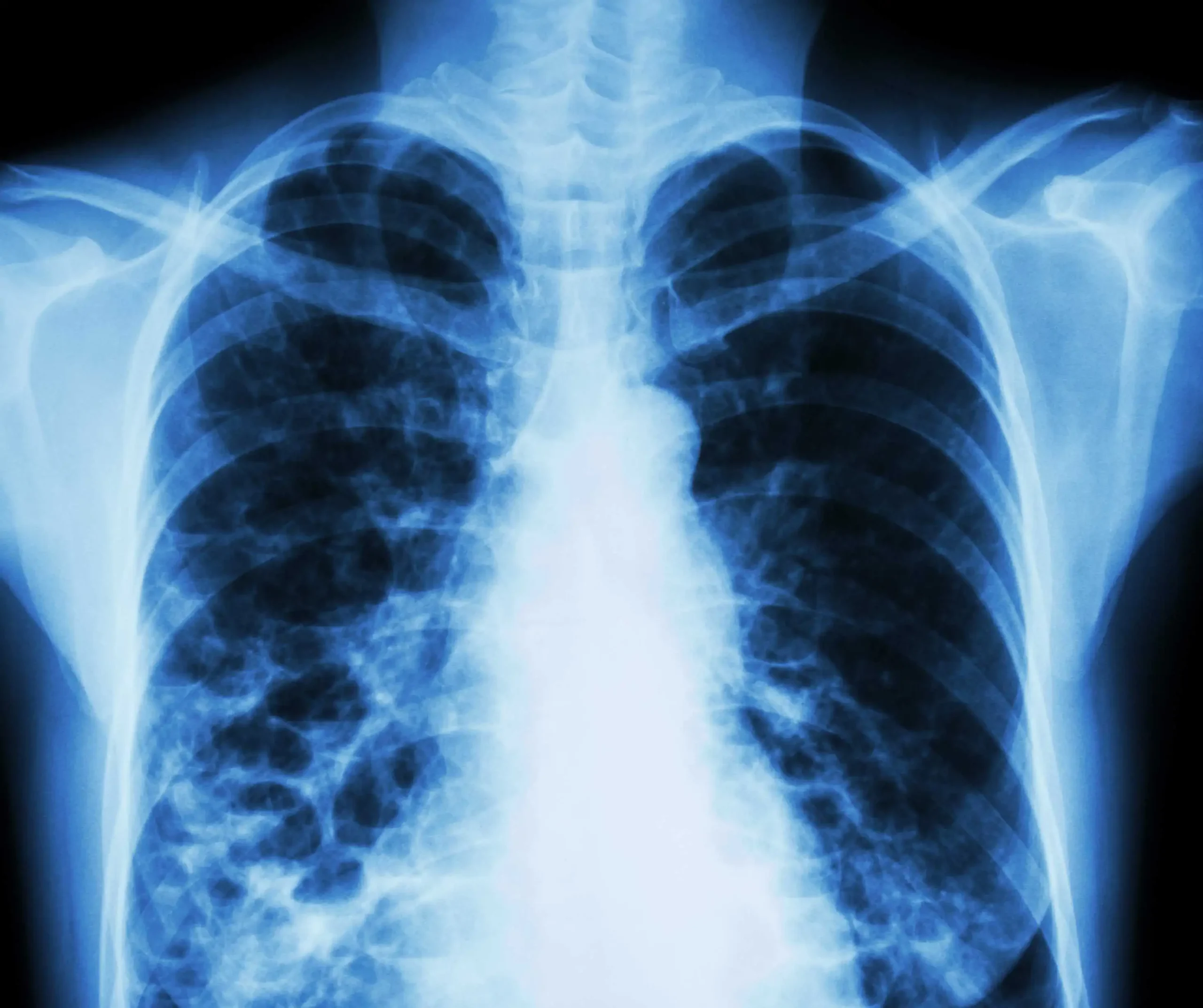 On-site chest X-ray and lab tests