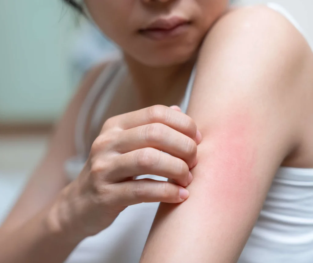 Rashes Treatment