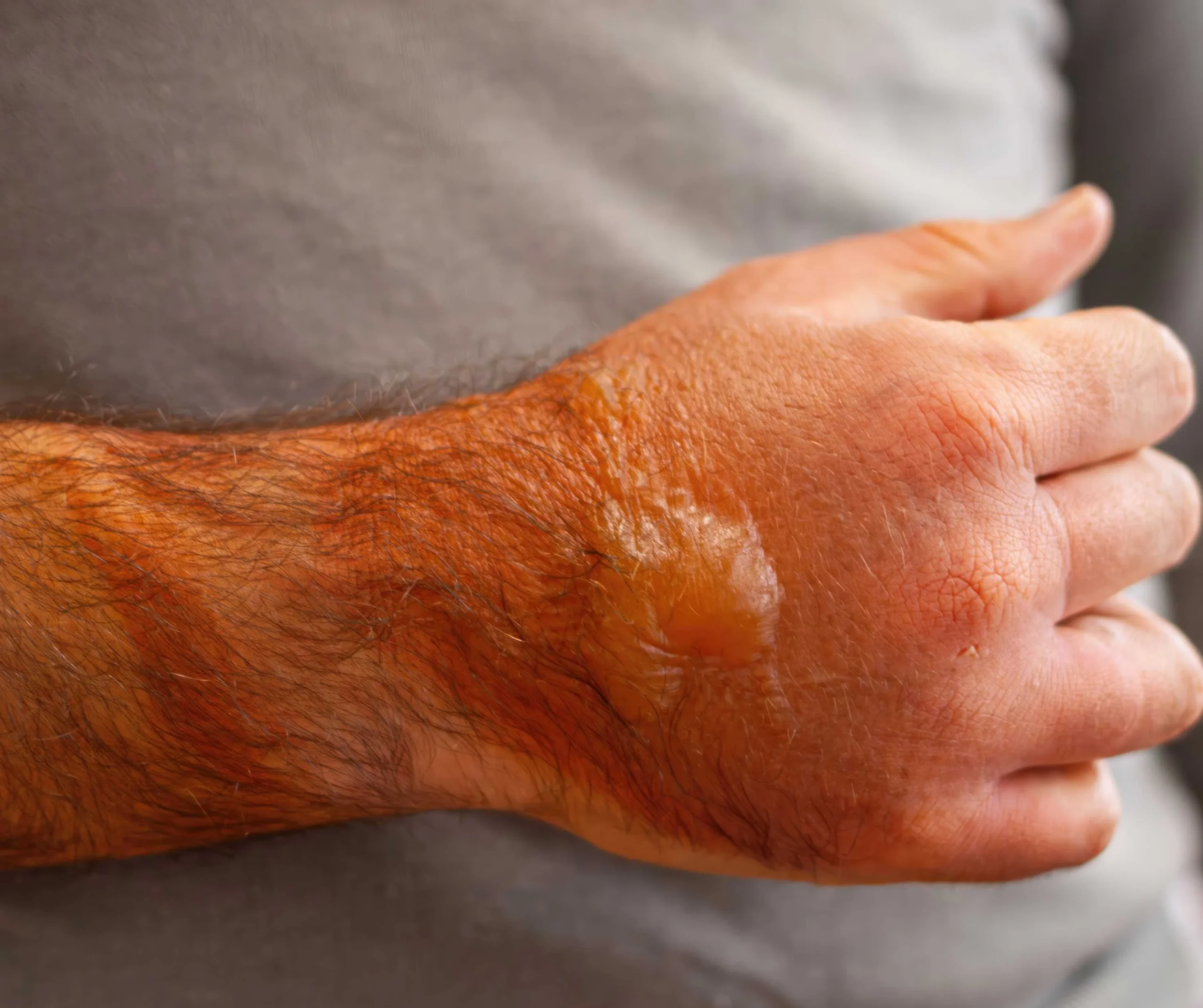 Second-Degree Burns
