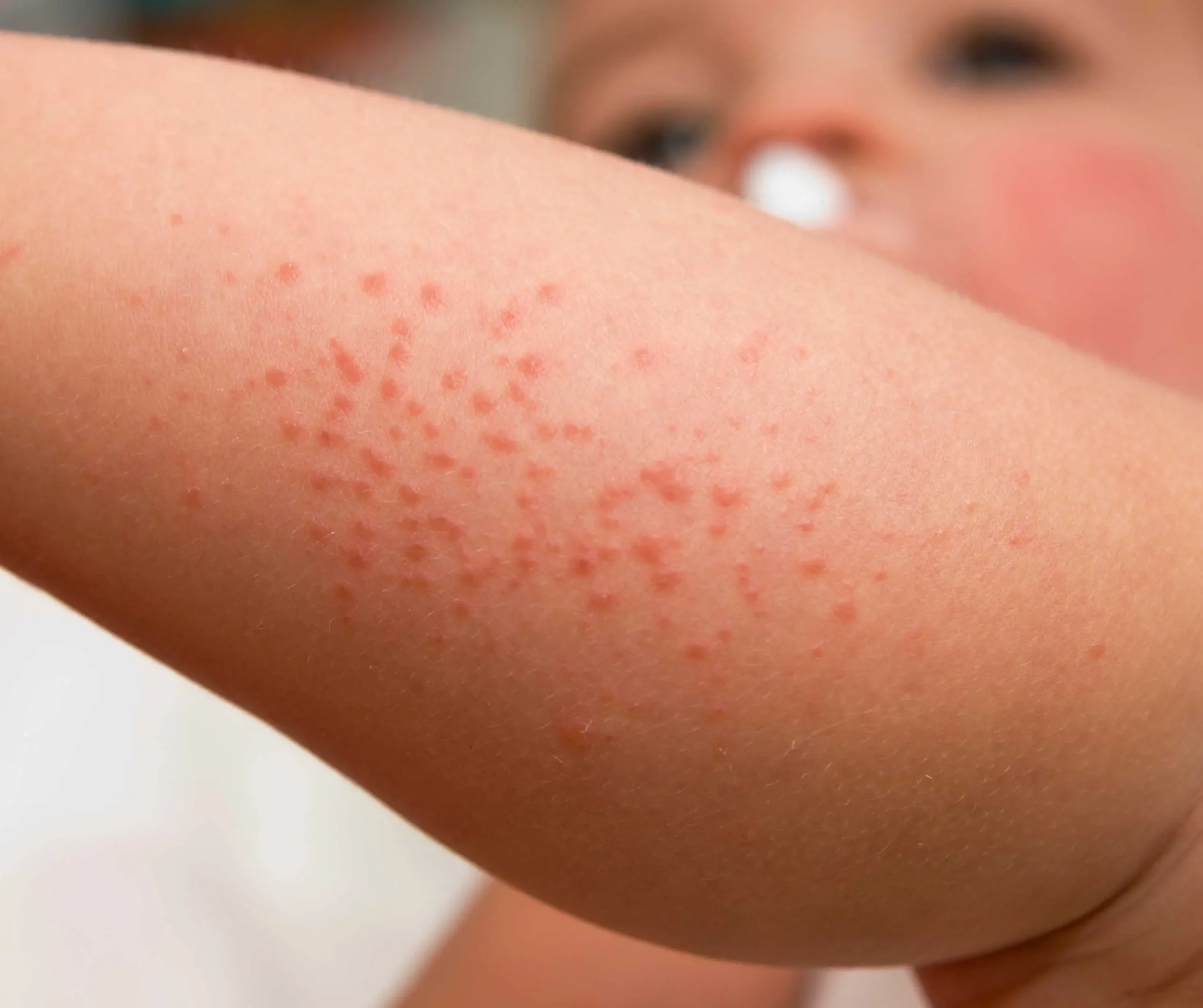 Skin Evaluation and Diagnosis