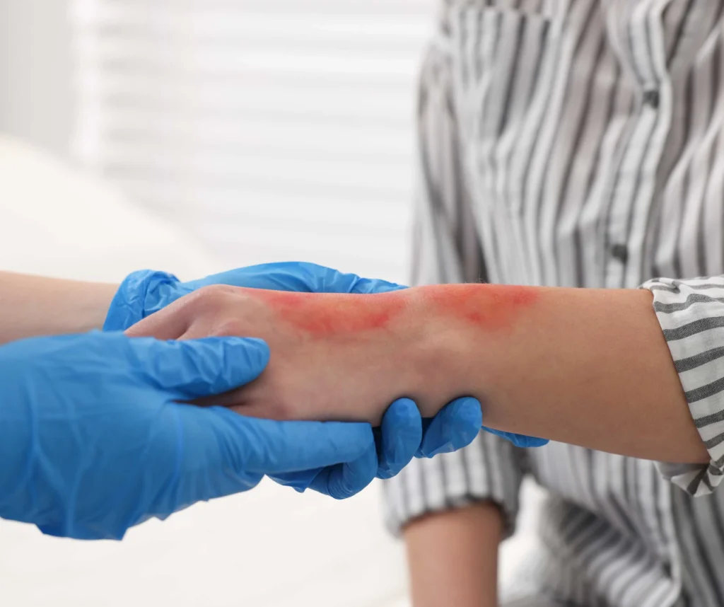 Walk-In Burn Treatment in Plano — No Appointment Needed