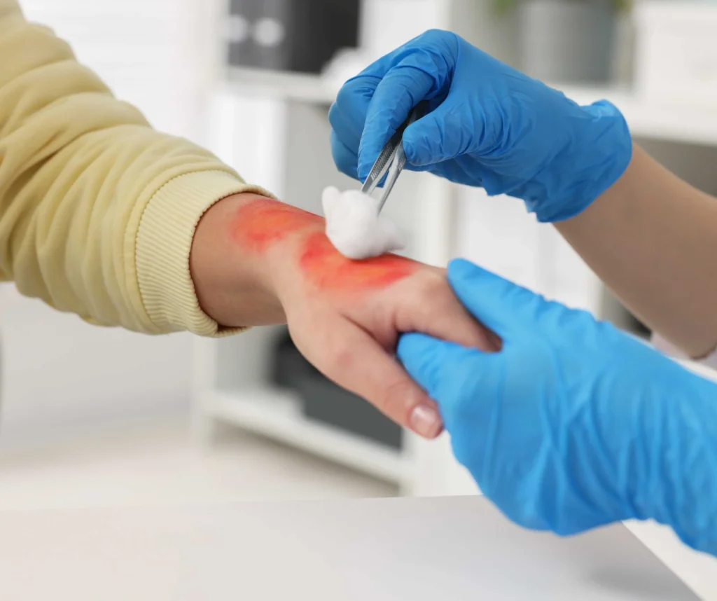 When to Visit the Emergency Room for a Burn