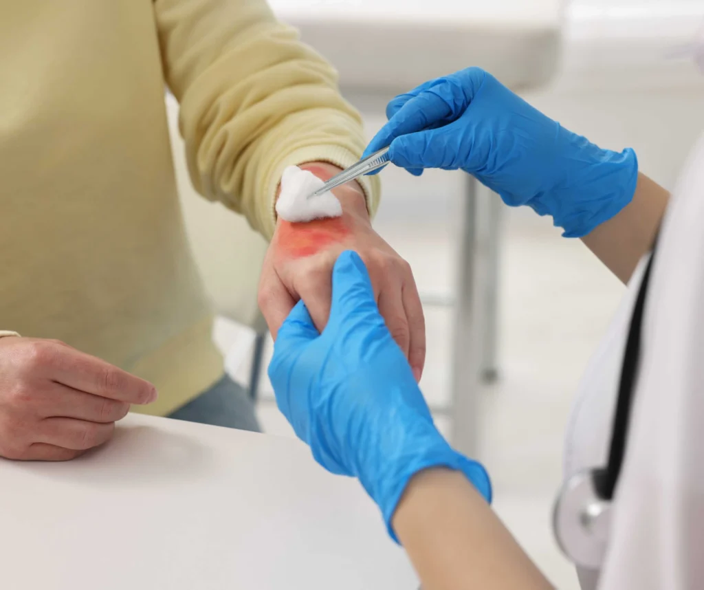 Why Choose Plano ER for Burn Emergencies