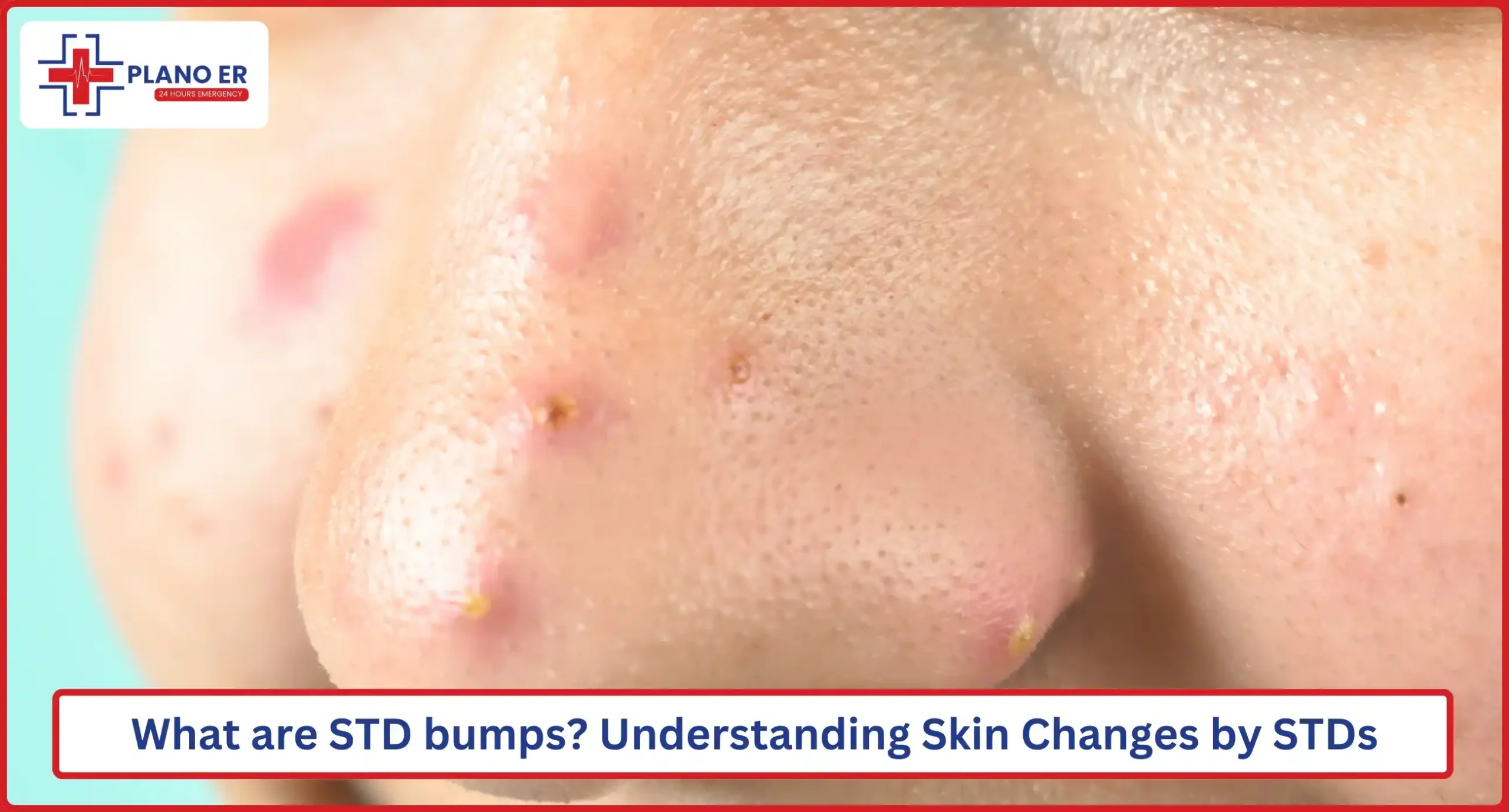 What are STD bumps Understanding Skin Changes by STDs