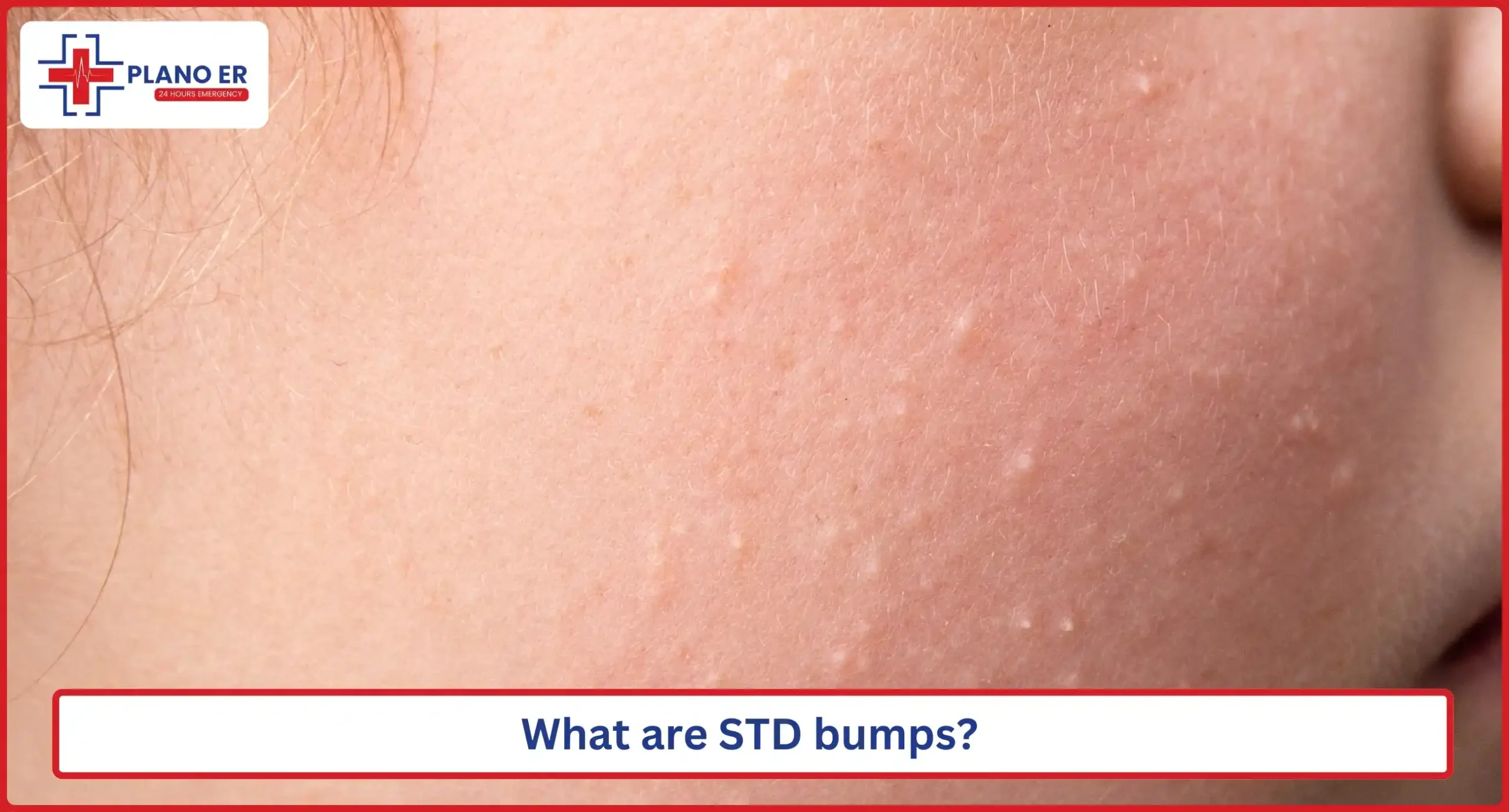 What are STD bumps