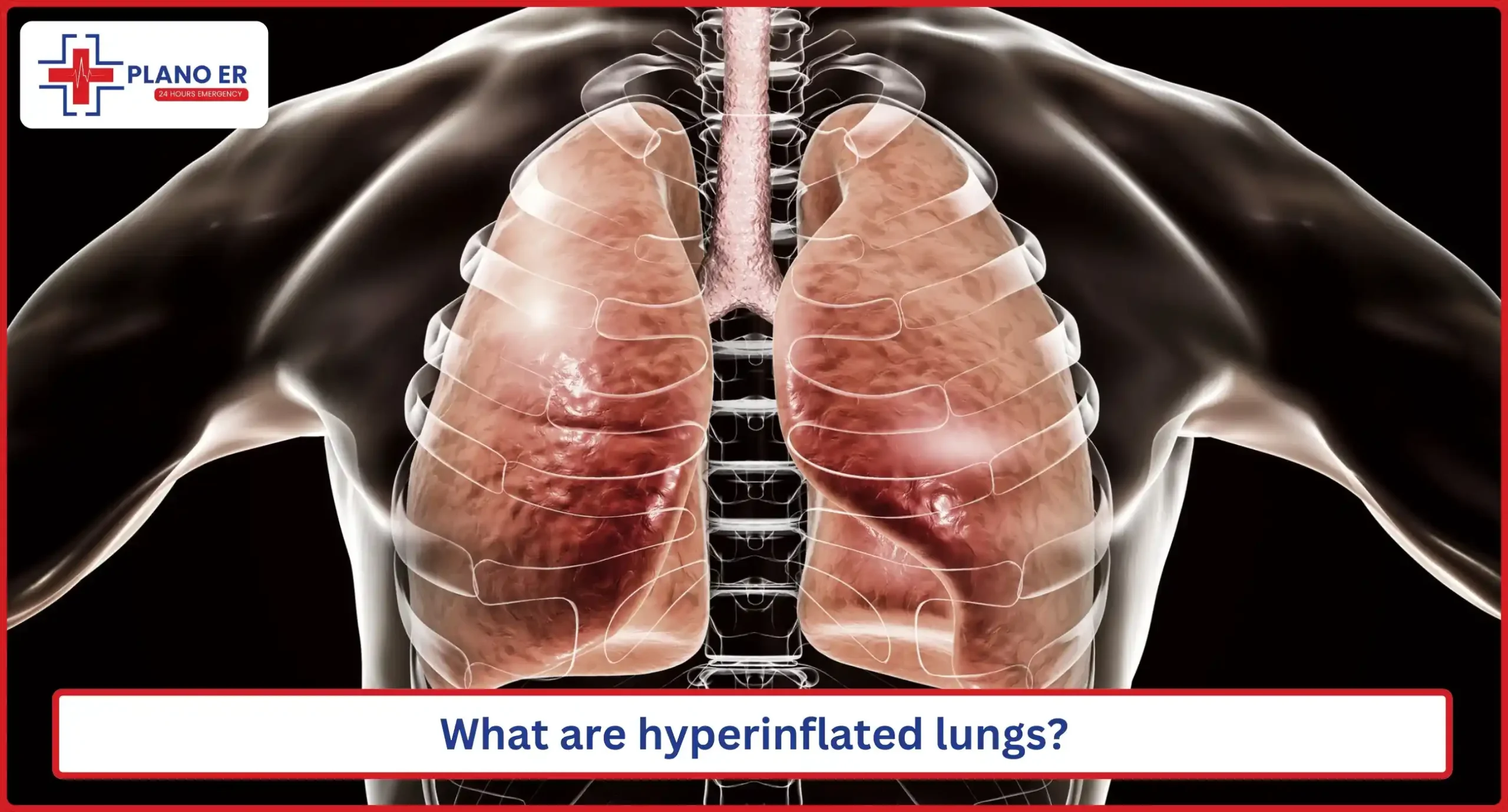 What are hyperinflated lungs