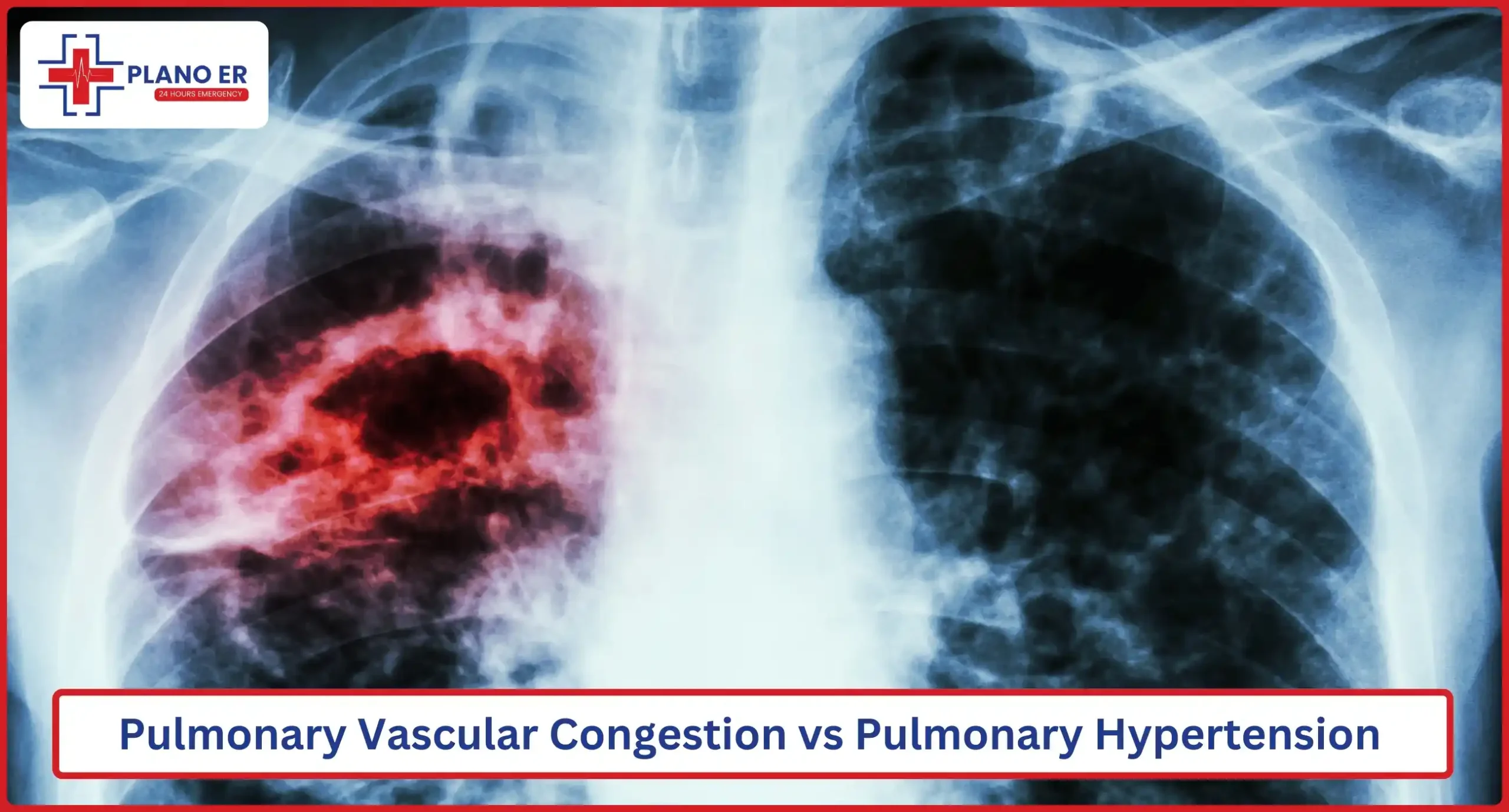 Pulmonary Vascular Congestion vs Pulmonary Hypertension