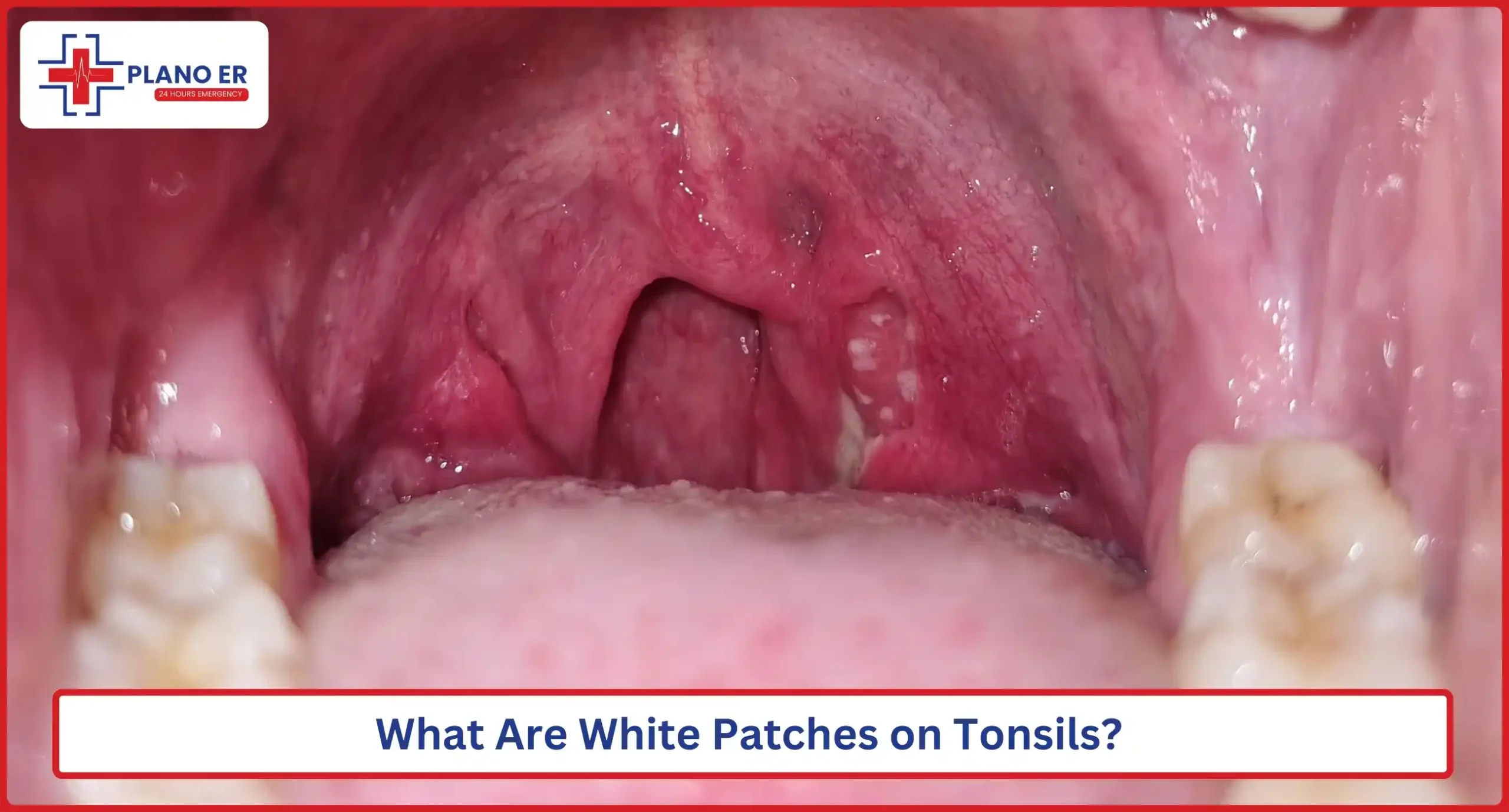 White Patches On Tonsils Causes Treatment At Plano ER White Patches On Tonsils Causes Treatment At Plano ER
