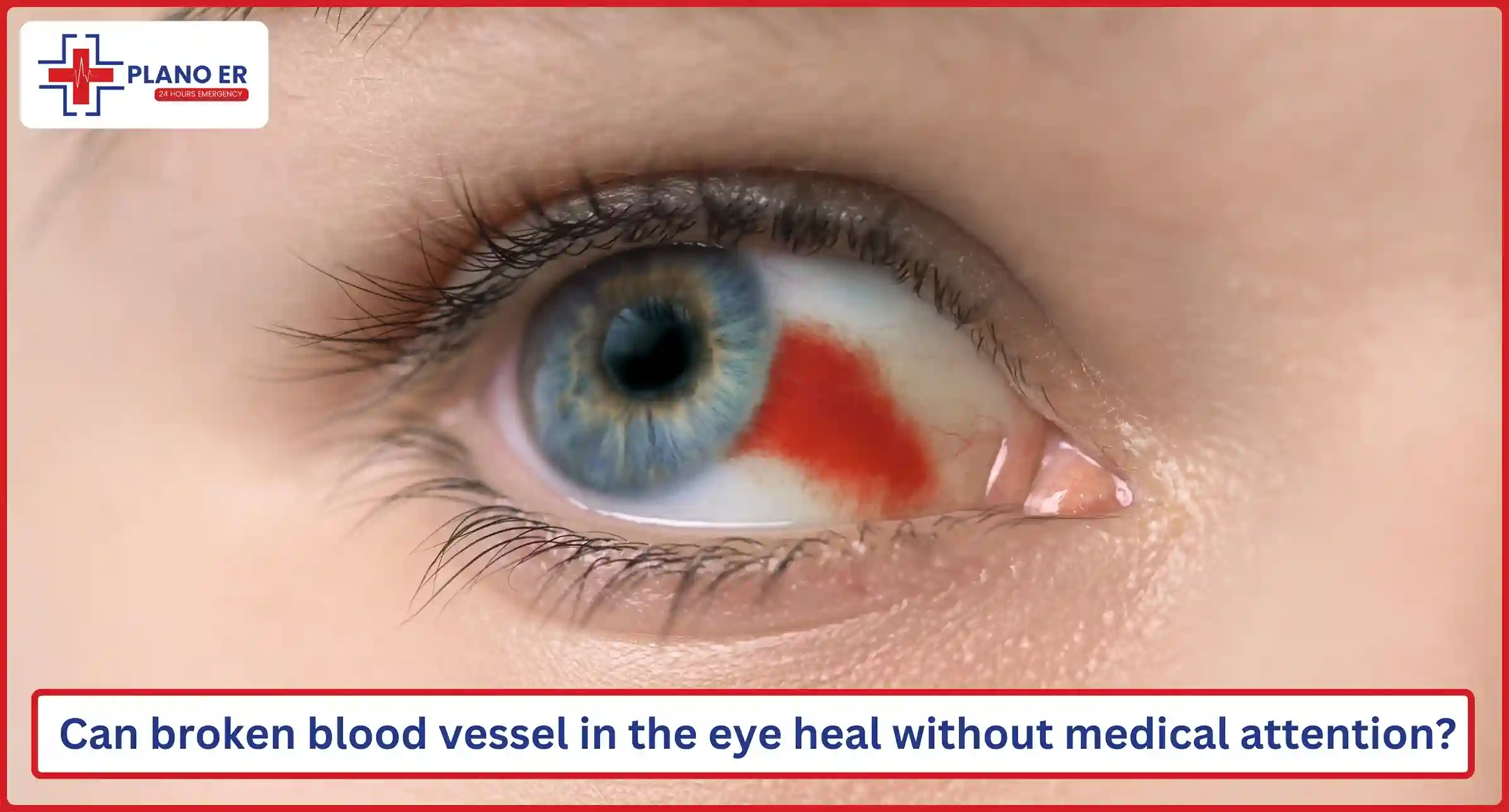 Can a broken blood vessel in the eye heal without medical attention