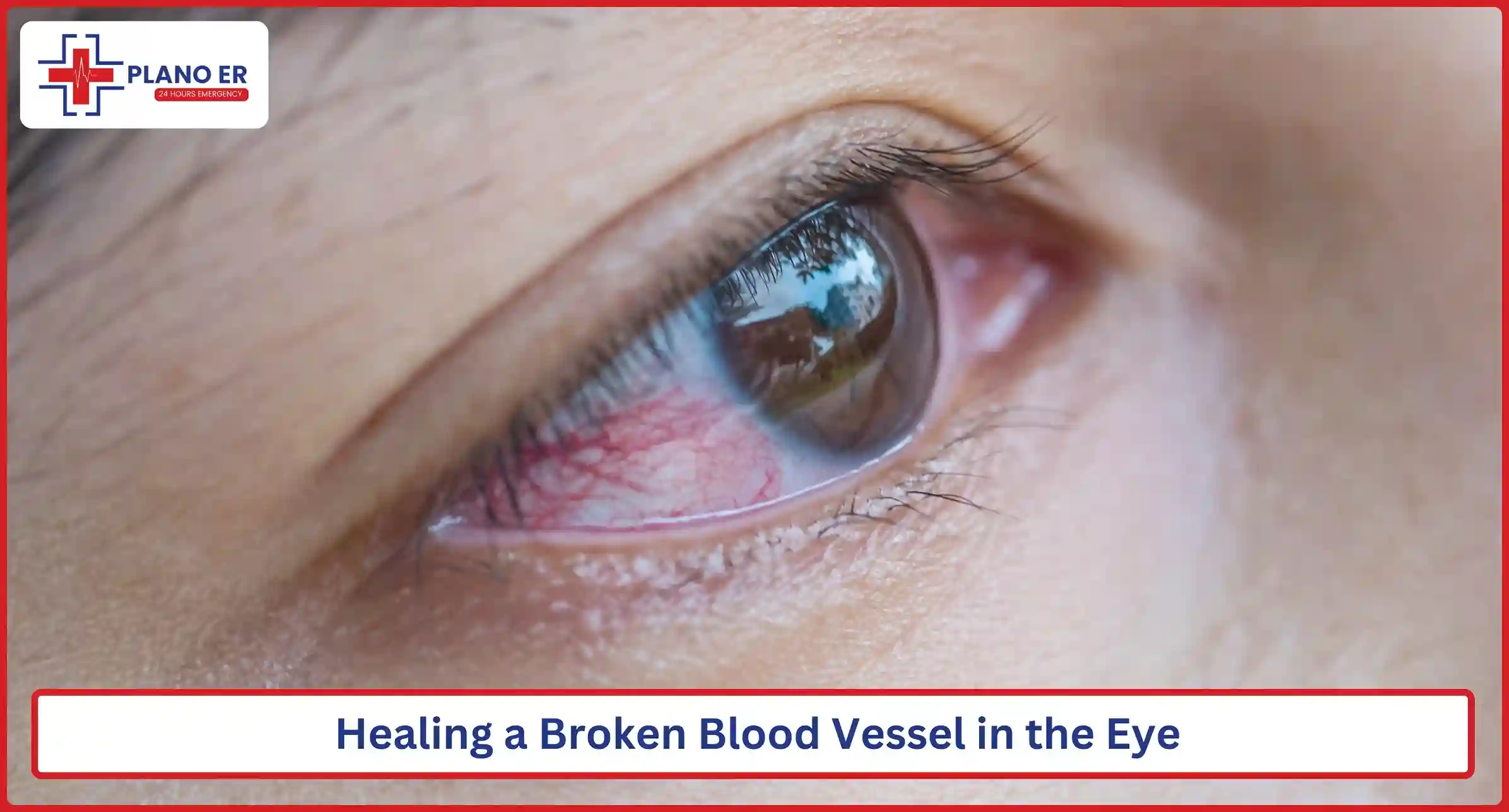 Healing a Broken Blood Vessel in the Eye