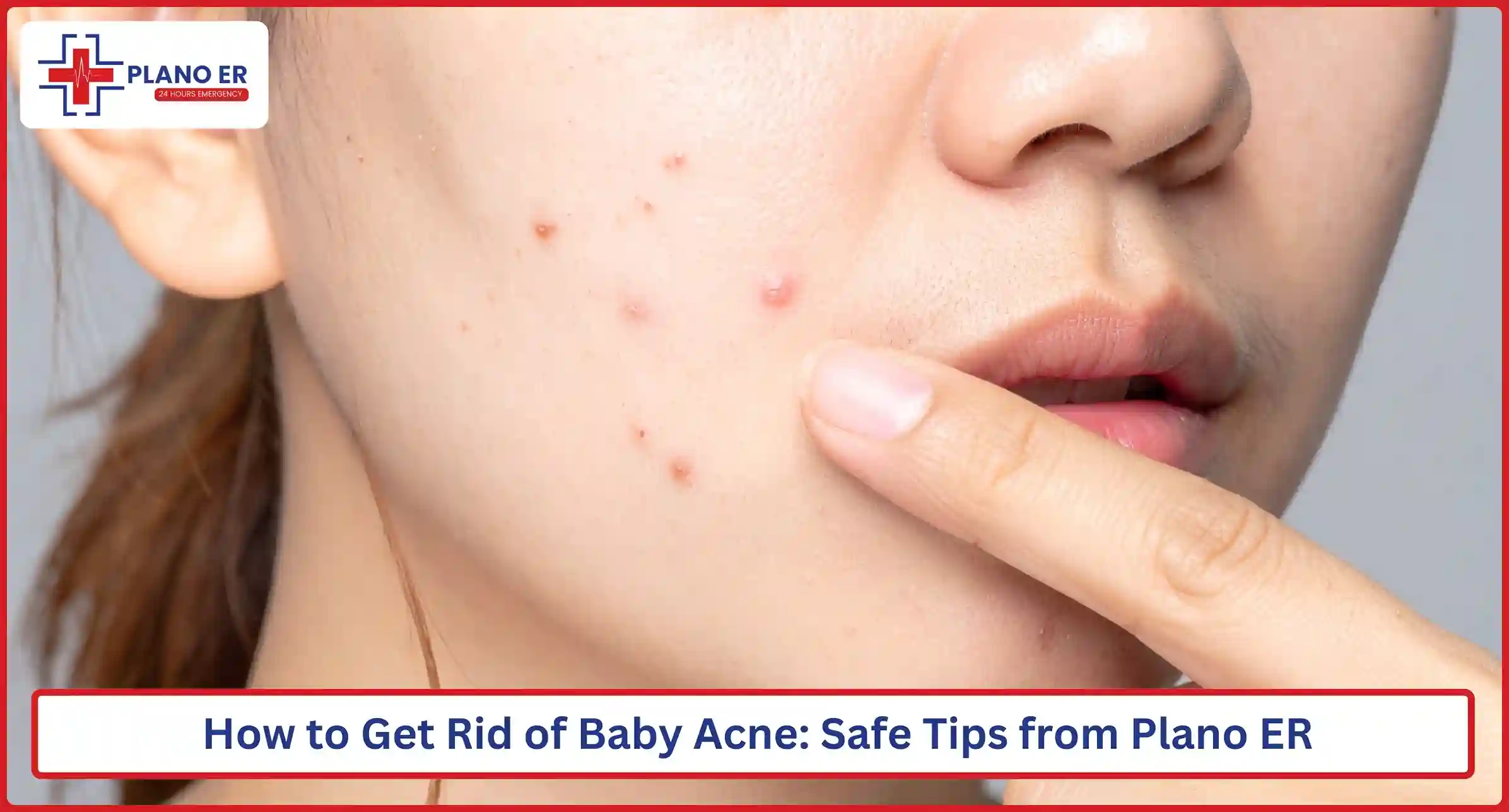 How to Get Rid of Baby Acne Safe Tips from Plano ER