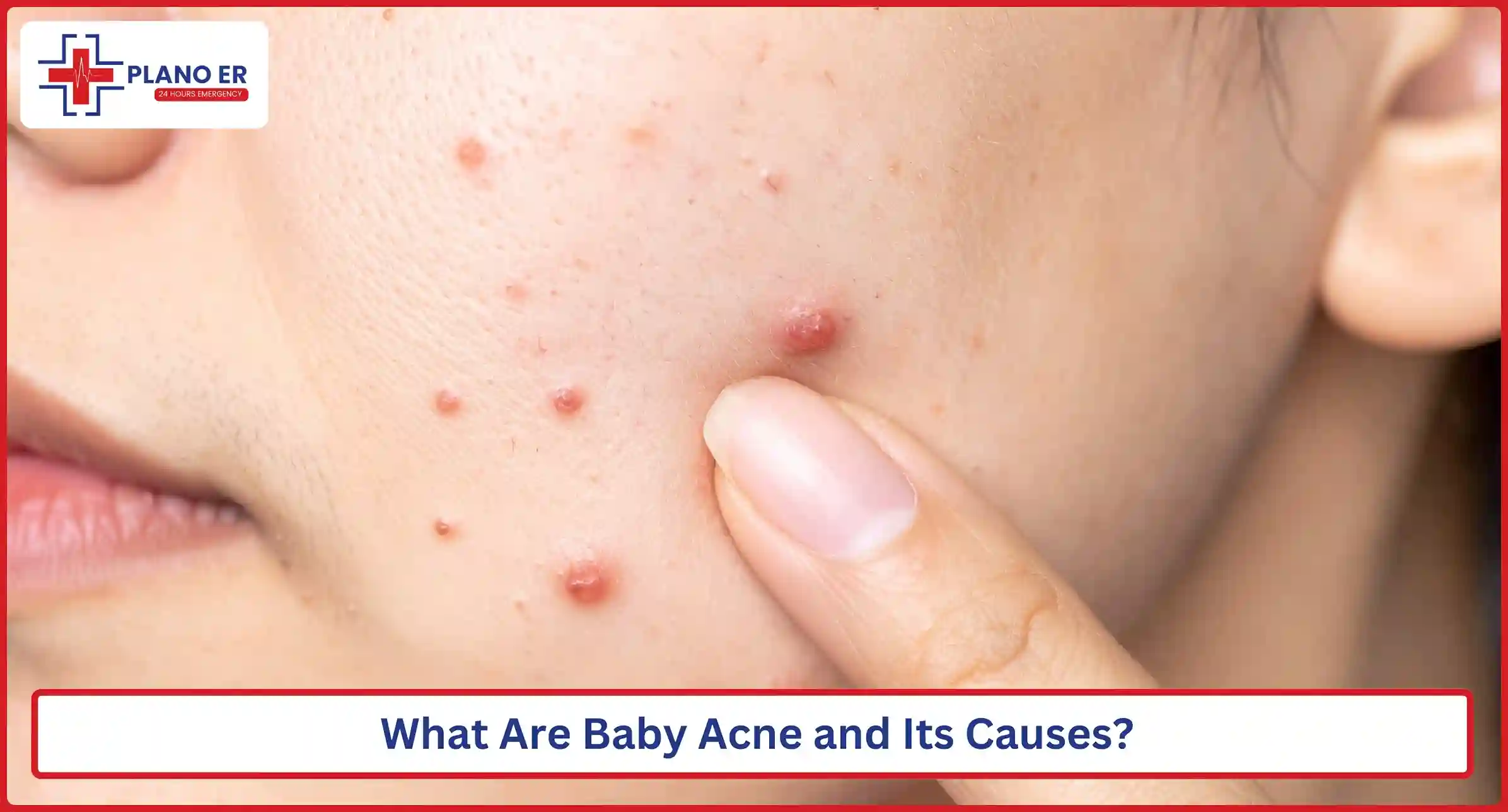 What Are Baby Acne and Its Causes