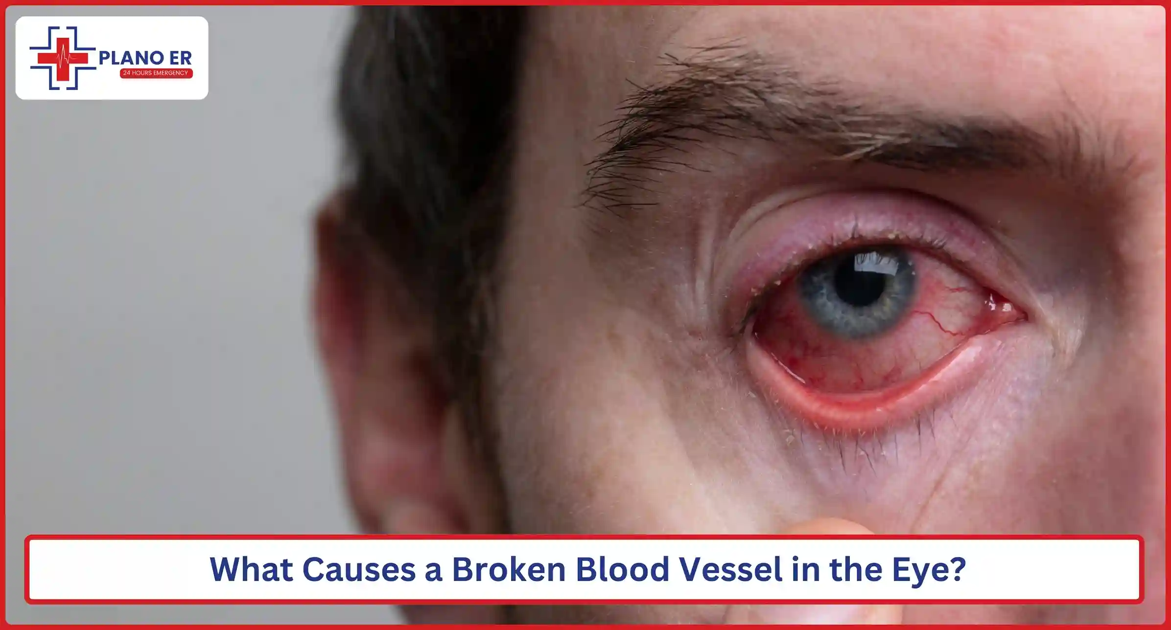 What Causes a Broken Blood Vessel in the Eye
