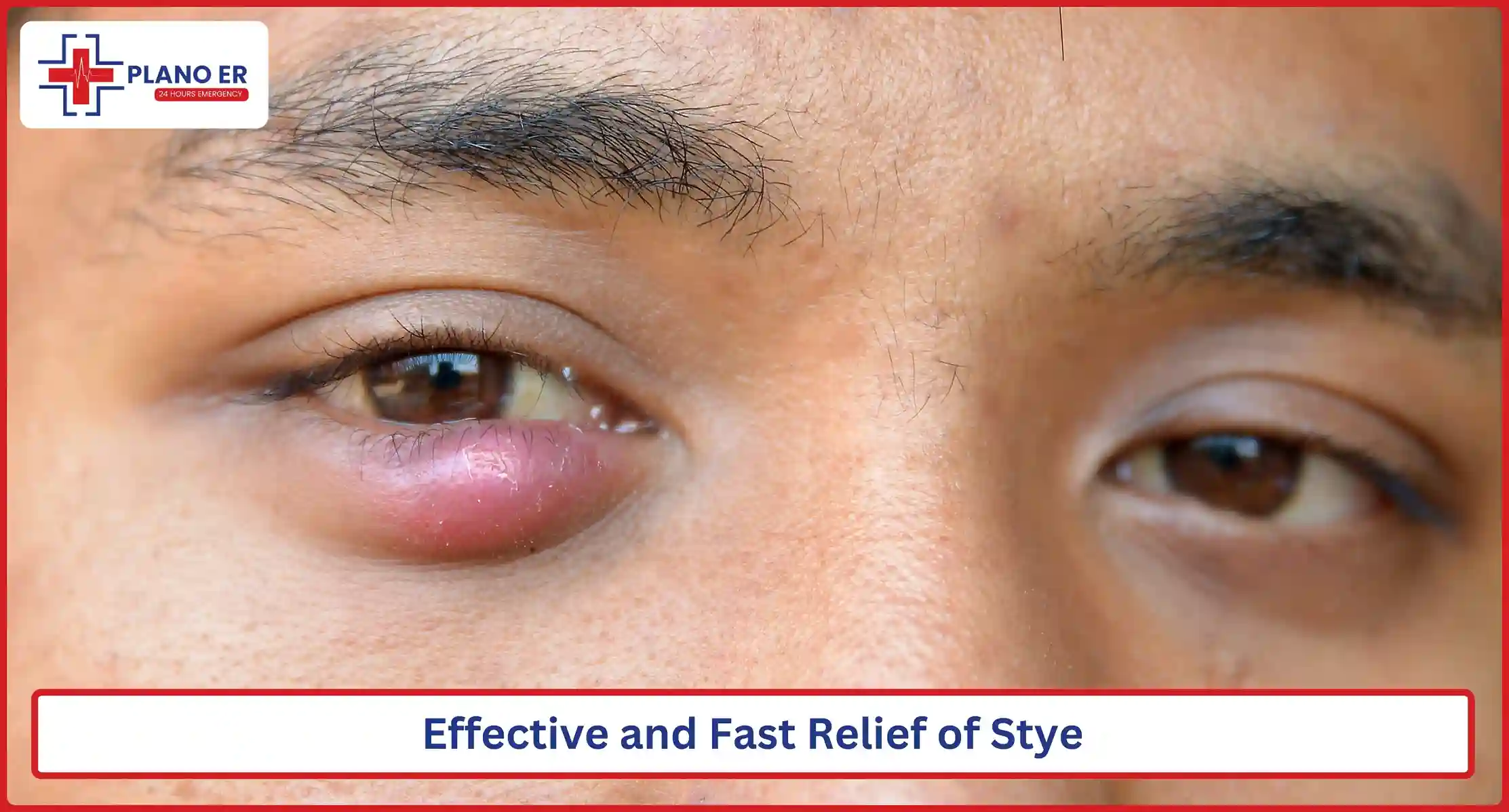 Effective and Fast Relief of Stye