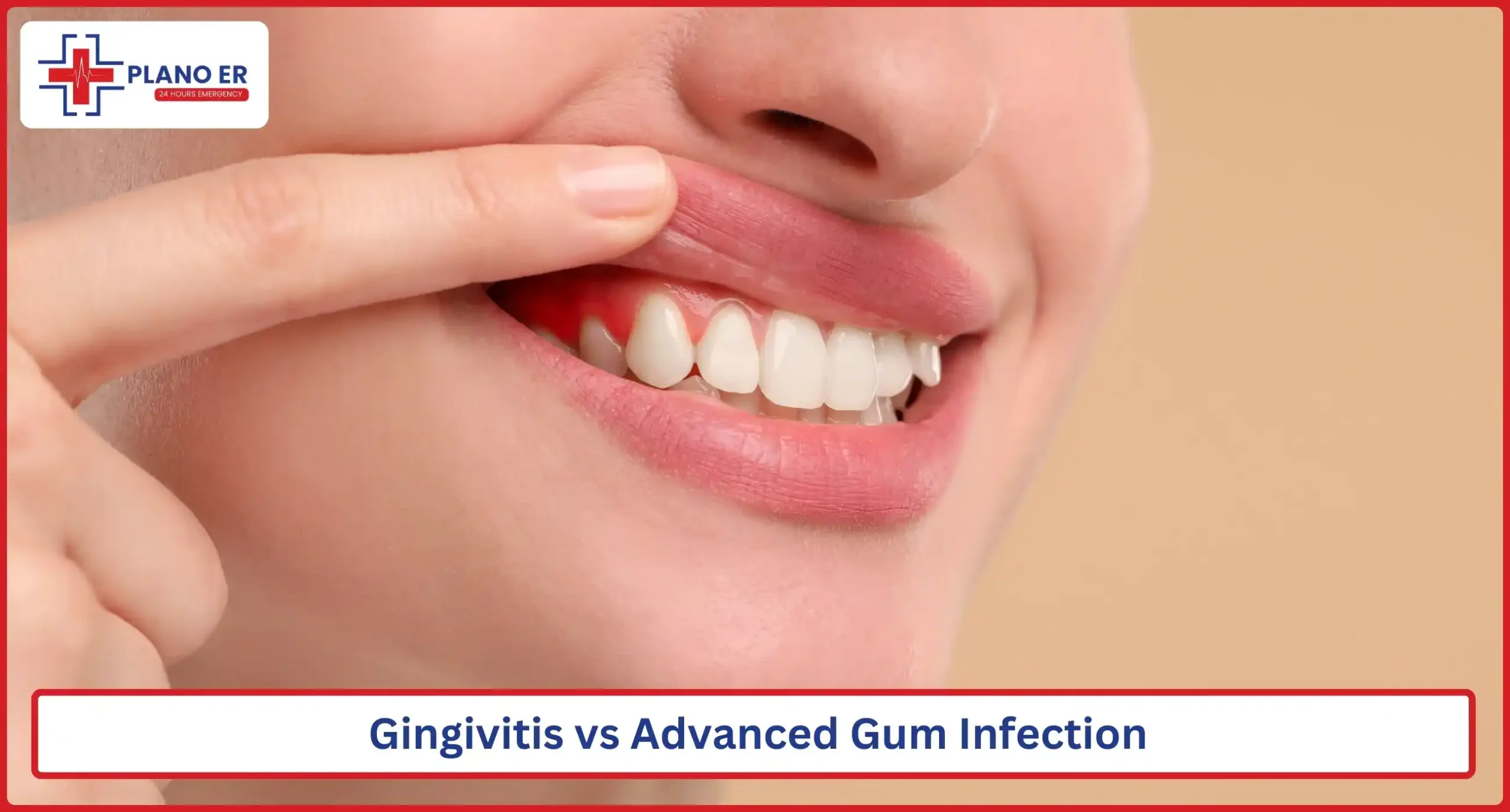 Gingivitis vs Advanced Gum Infection