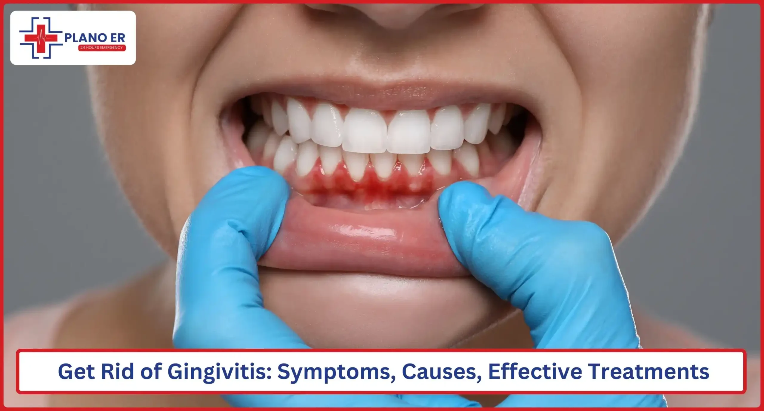 How to Get Rid of Gingivitis Symptoms, Causes, Effective Treatments