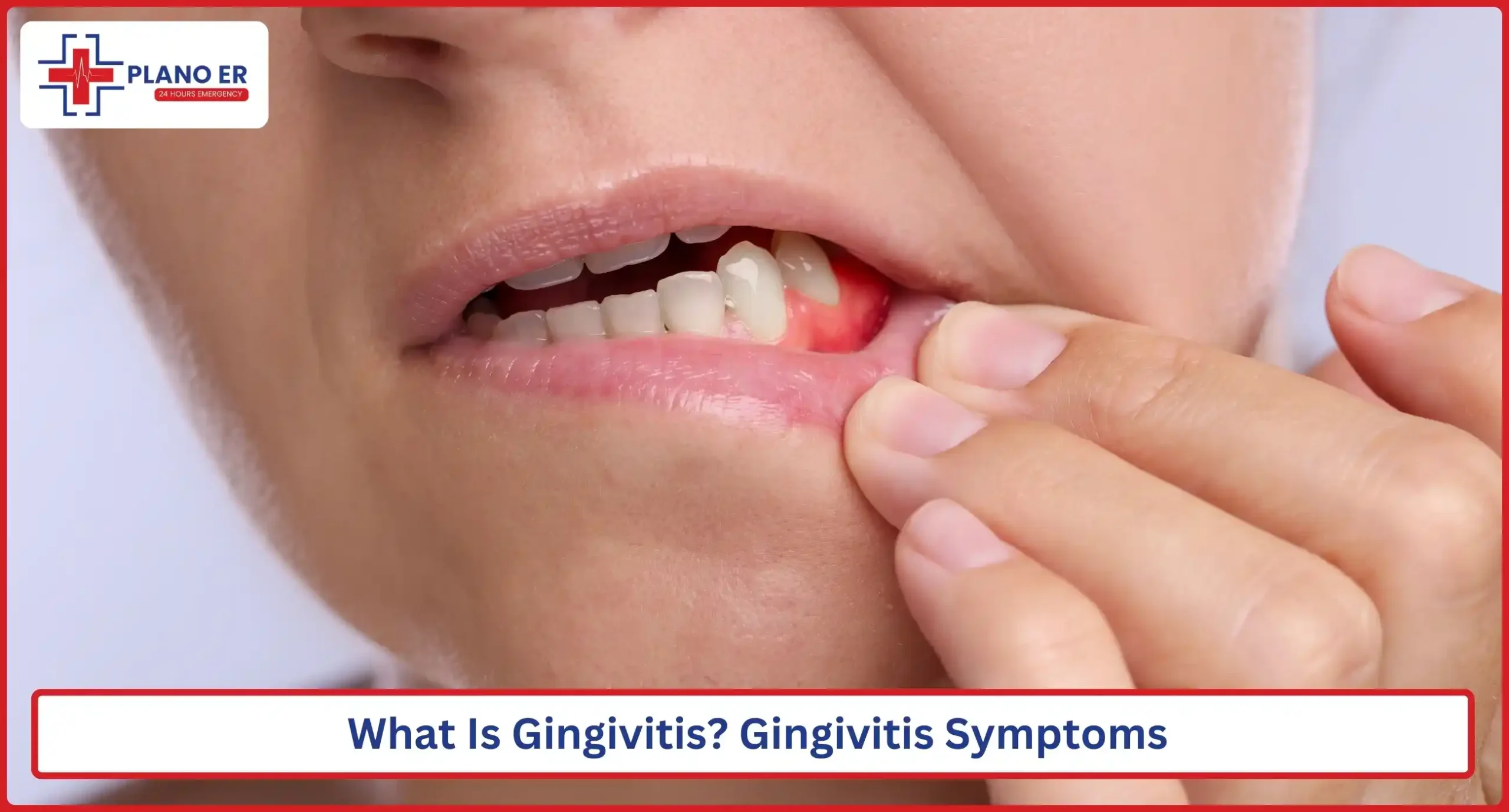 What Is Gingivitis