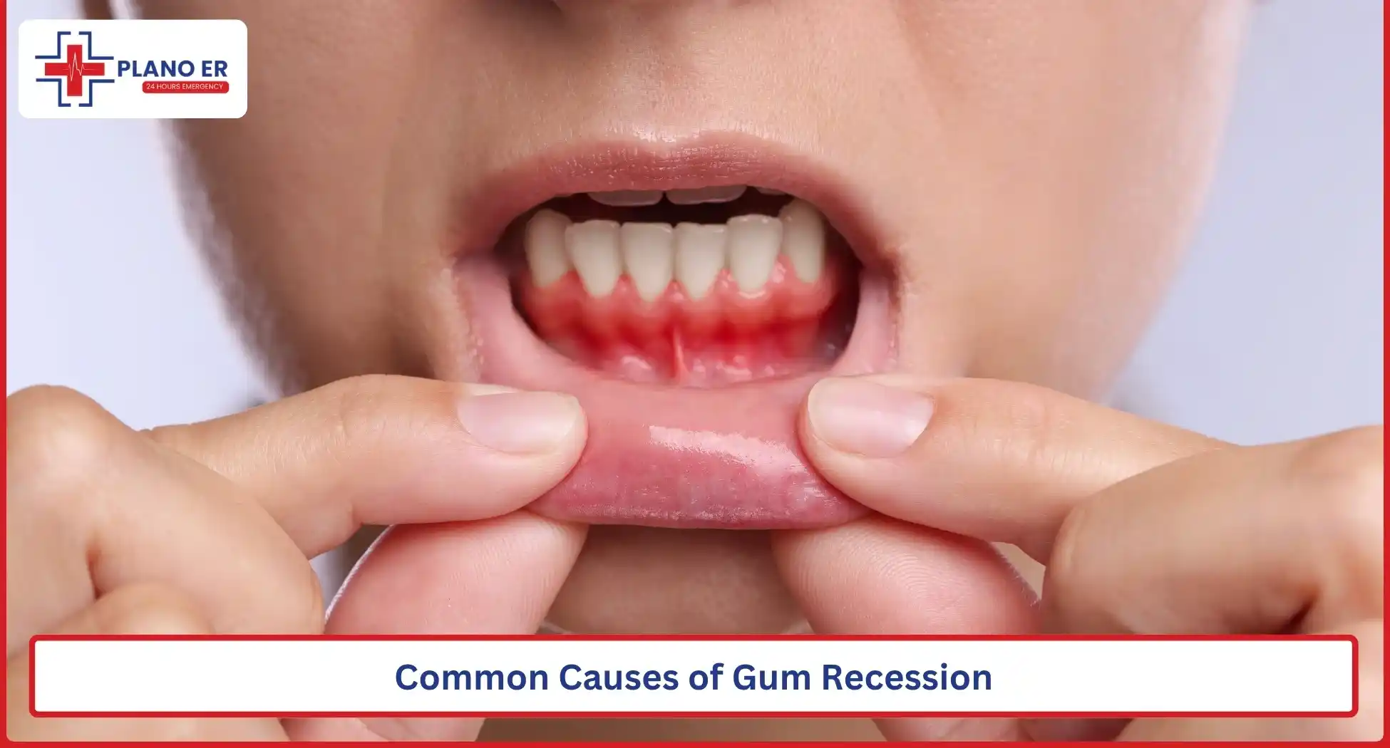 Common Causes of Gum Recession