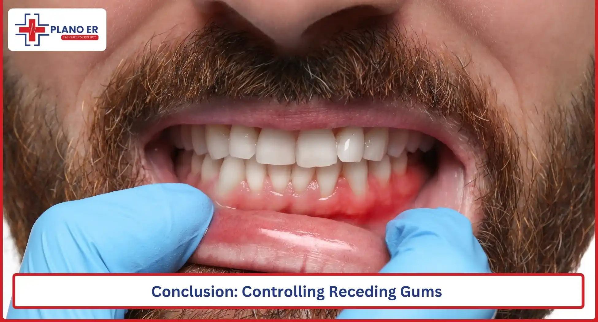 Conclusion Controlling Receding Gums