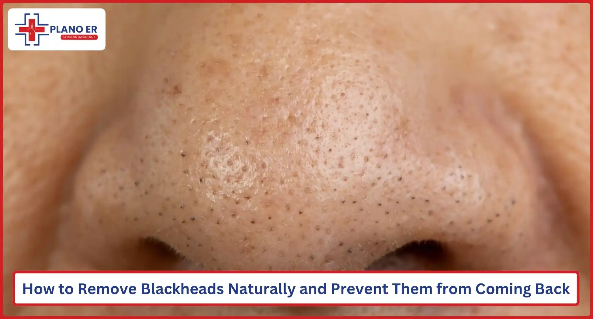 How to Remove Blackheads Naturally and Prevent Them from Coming Back