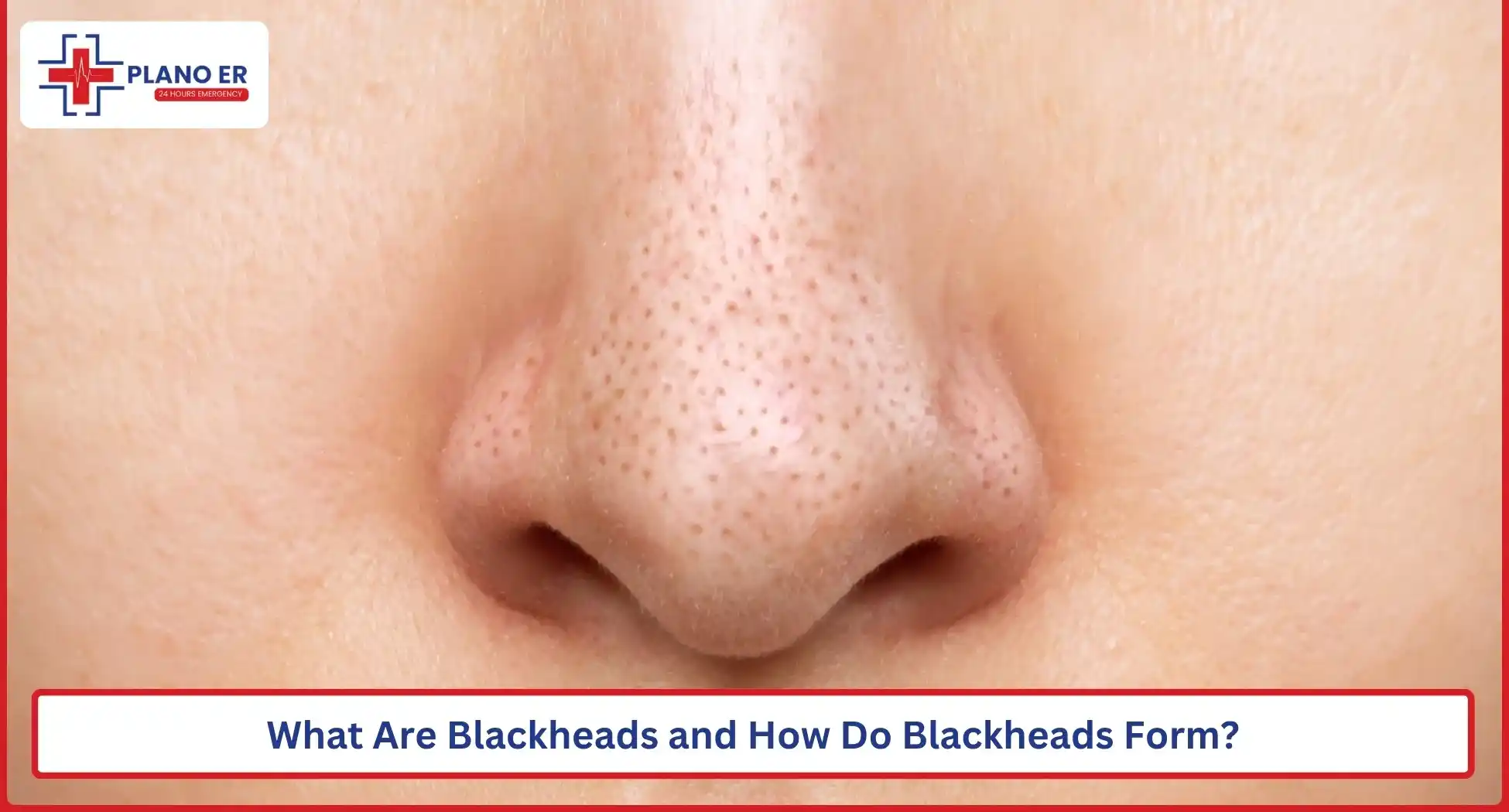 What Are Blackheads and How Do Blackheads Form