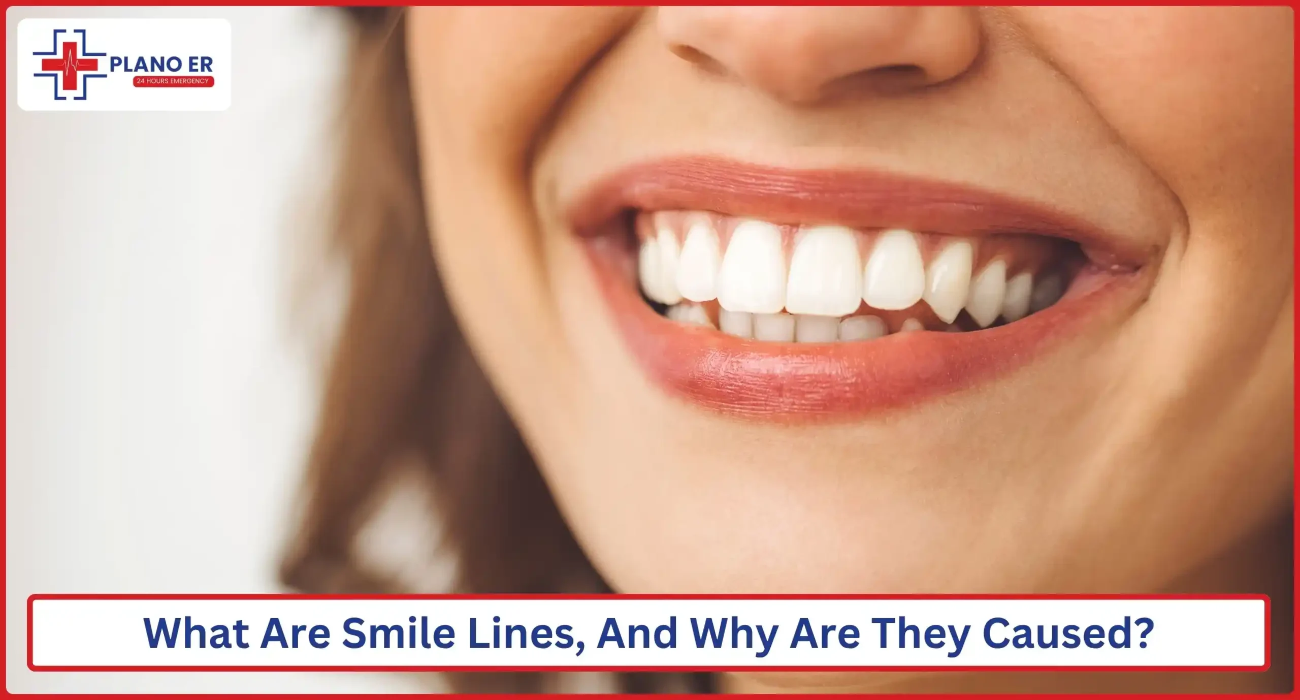 What Are Smile Lines, And Why Are They Caused