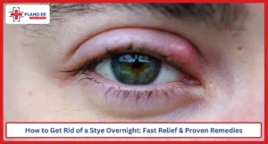 How to Get Rid of a Stye Overnight Fast Relief & Proven Remedies