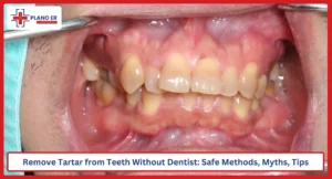 How to Remove Tartar from Teeth Without Dentist