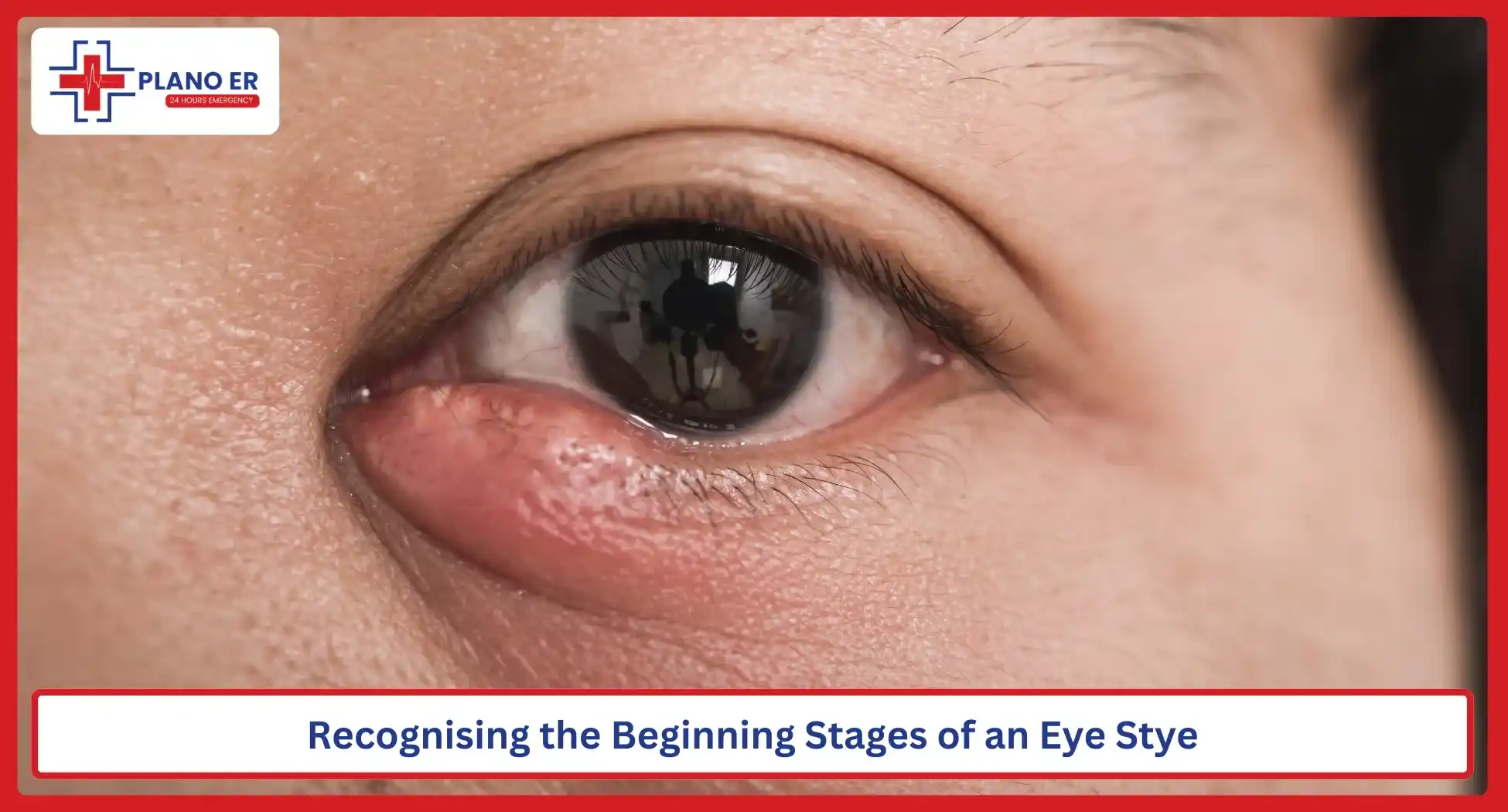 Recognising the Beginning Stages of an Eye Stye