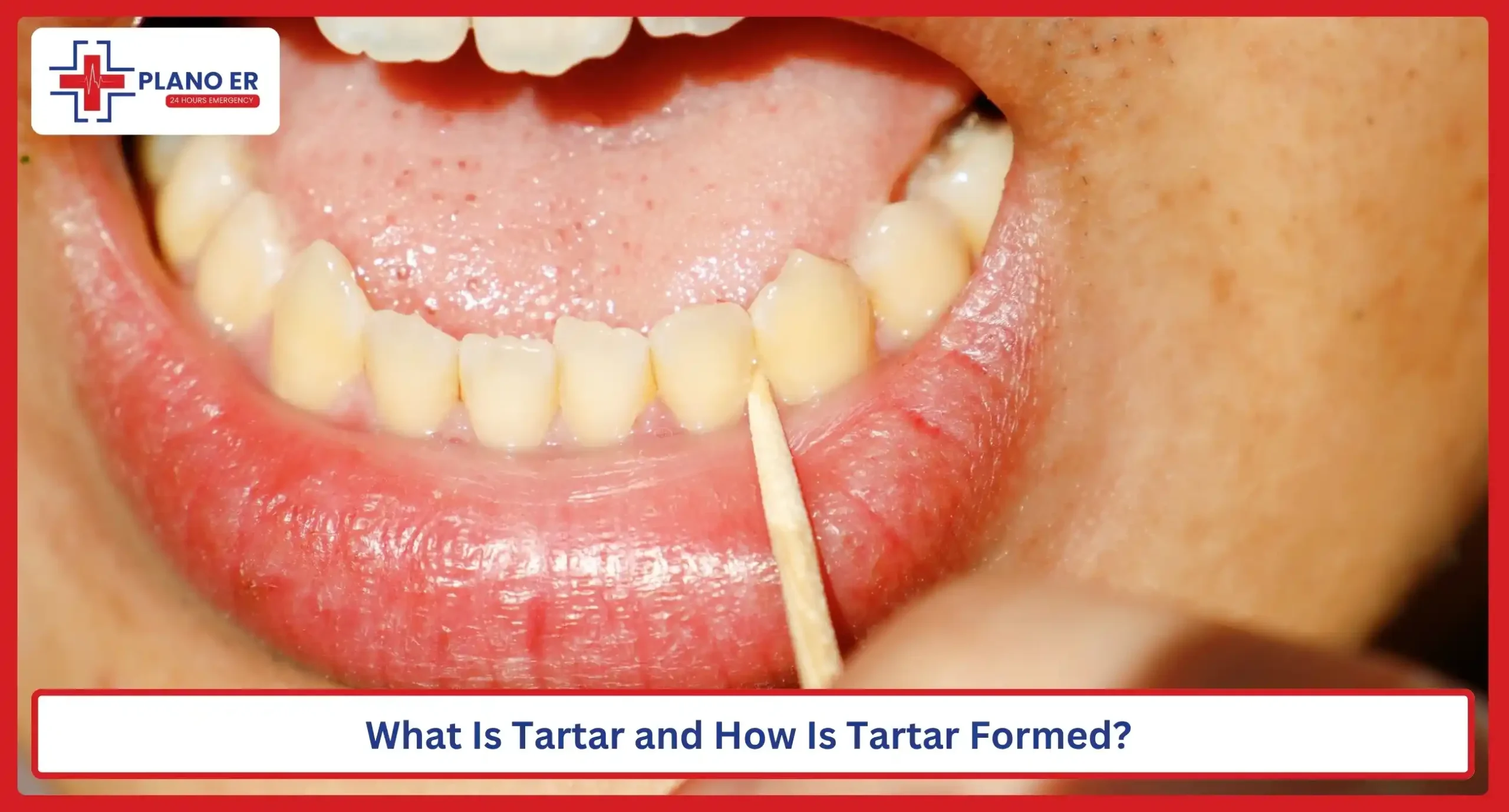 What Is Tartar and How Is Tartar Formed
