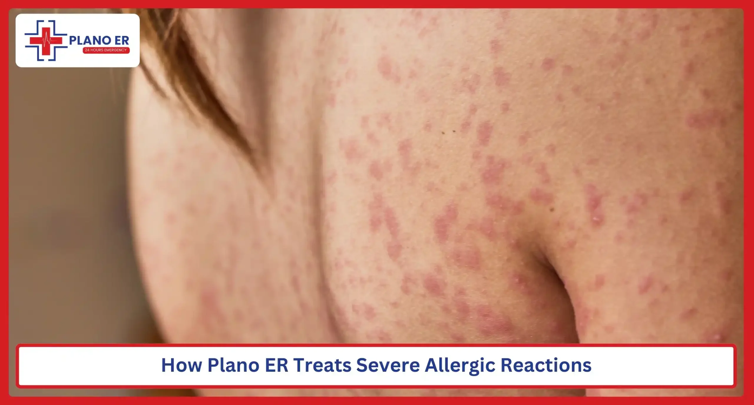 How Plano ER Treats Severe Allergic Reactions