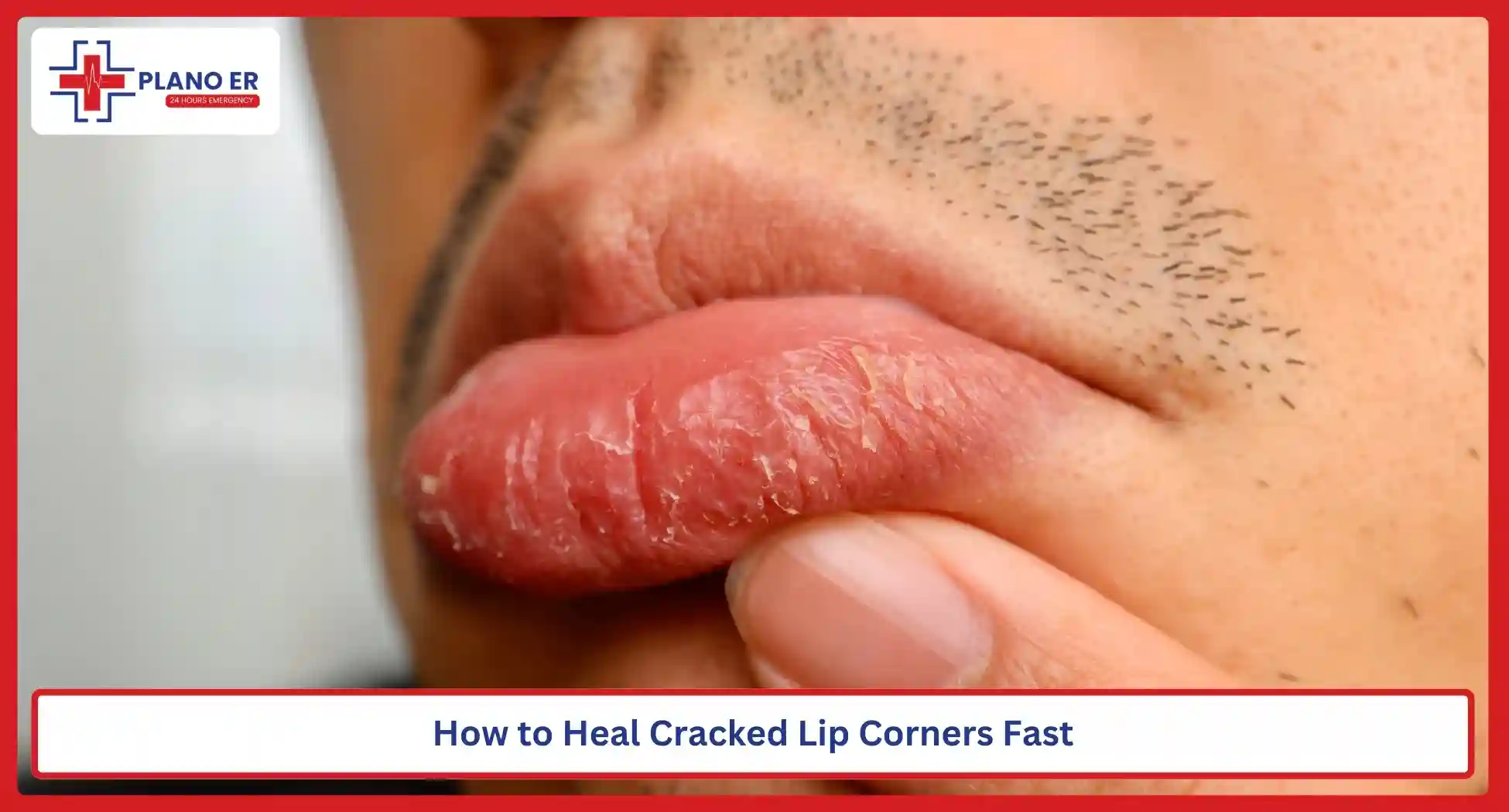 How to Heal Cracked Lip Corners Fast