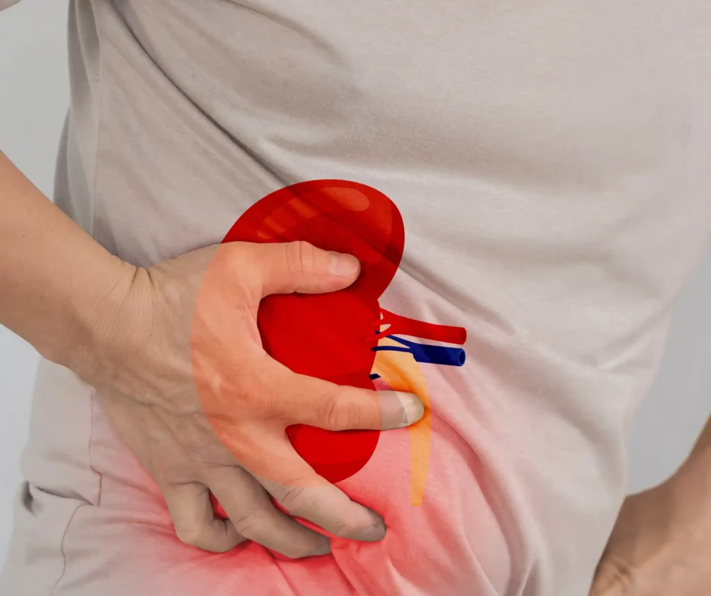 Kidney Stone, Kidney Pain