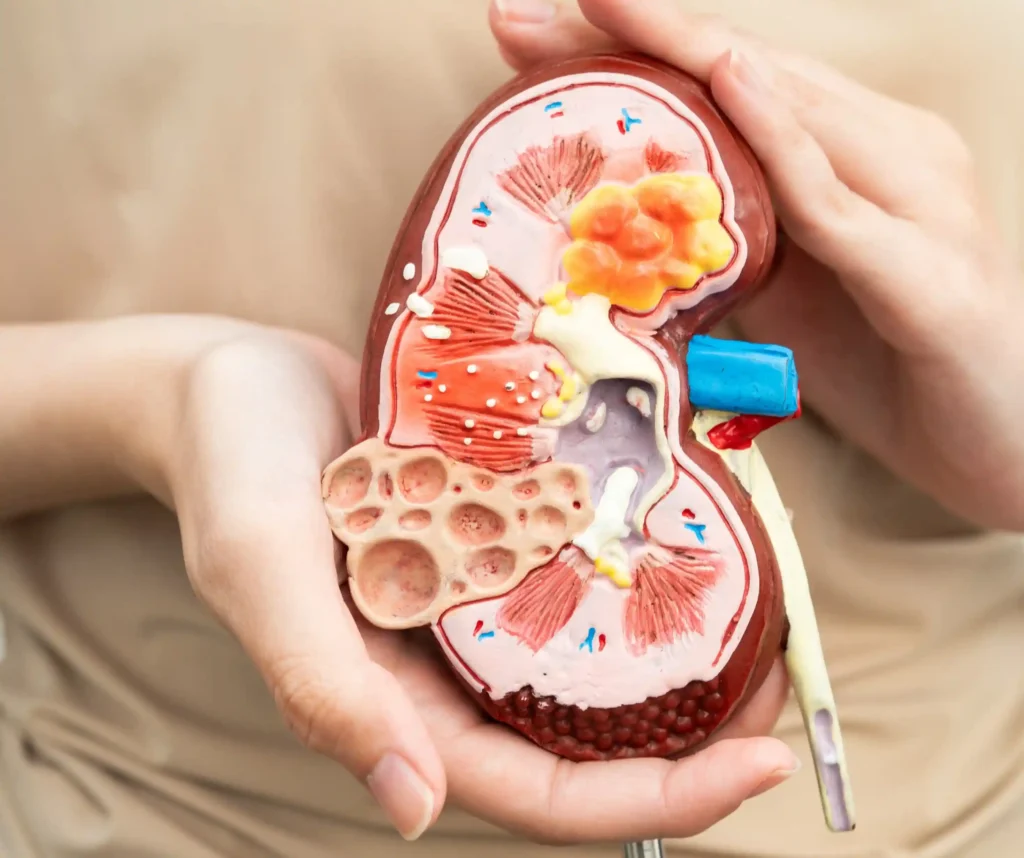 Kidney Stone, Kidney Pain