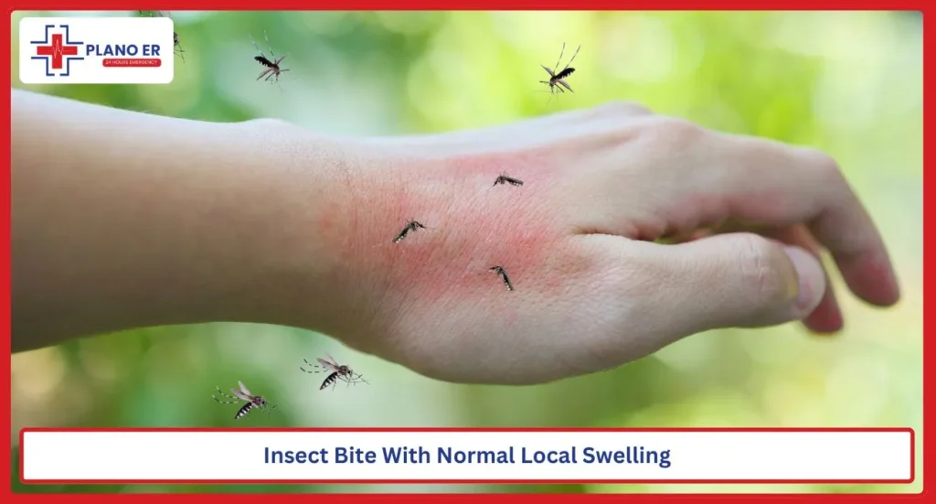 Swollen red skin after an insect bite