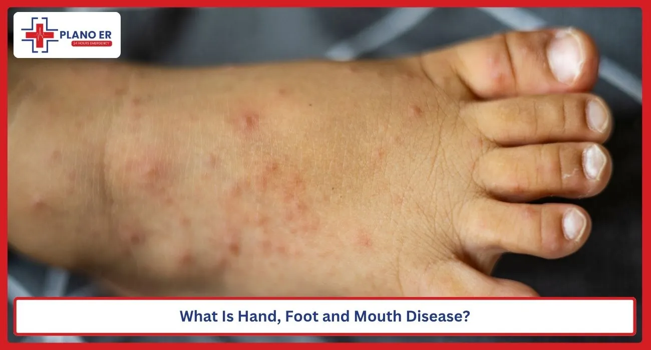 What Is Hand, Foot and Mouth Disease