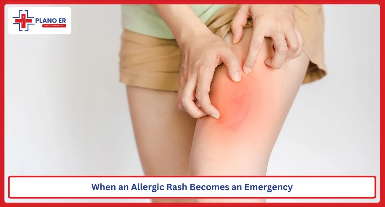 Severe allergic skin rash with facial swelling and hives